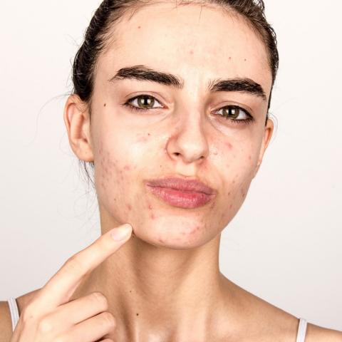 Hablemos del acné y sus causas