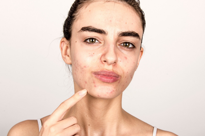 Hablemos del acné y sus causas